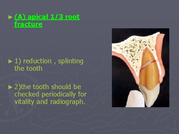 ► (A) apical 1/3 root fracture ► 1) reduction , splinting the tooth ►