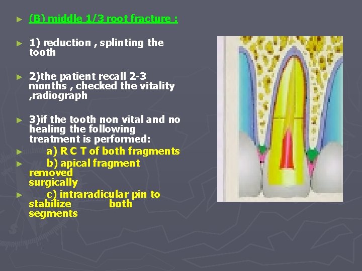 ► (B) middle 1/3 root fracture : ► 1) reduction , splinting the tooth