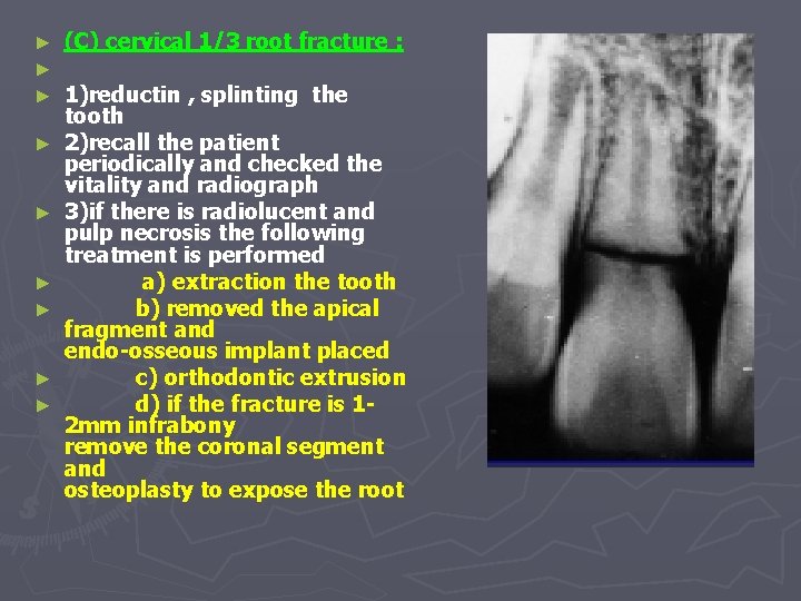 ► ► ► ► ► (C) cervical 1/3 root fracture : 1)reductin , splinting