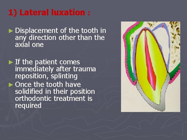 1) Lateral luxation : ► Displacement of the tooth in any direction other than