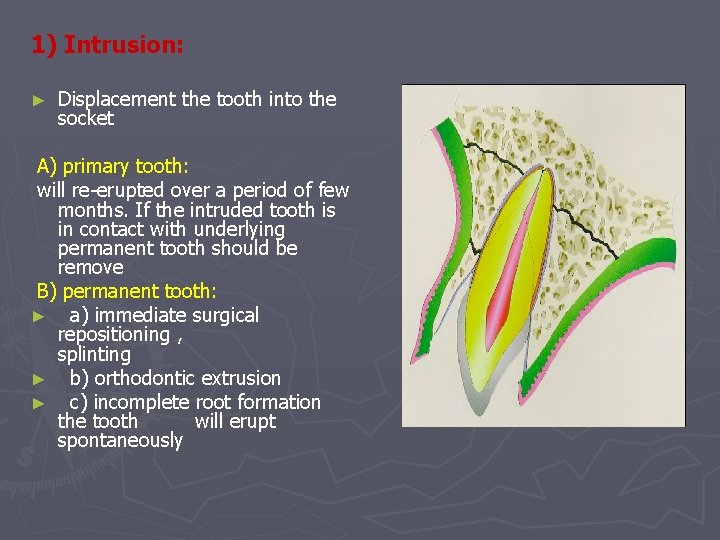 1) Intrusion: ► Displacement the tooth into the socket A) primary tooth: will re-erupted