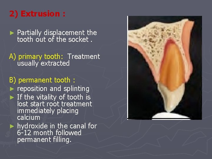 2) Extrusion : ► Partially displacement the tooth out of the socket. A) primary
