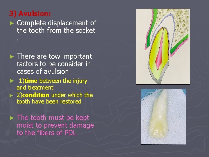 3) Avulsion: ► Complete displacement of the tooth from the socket. ► There are