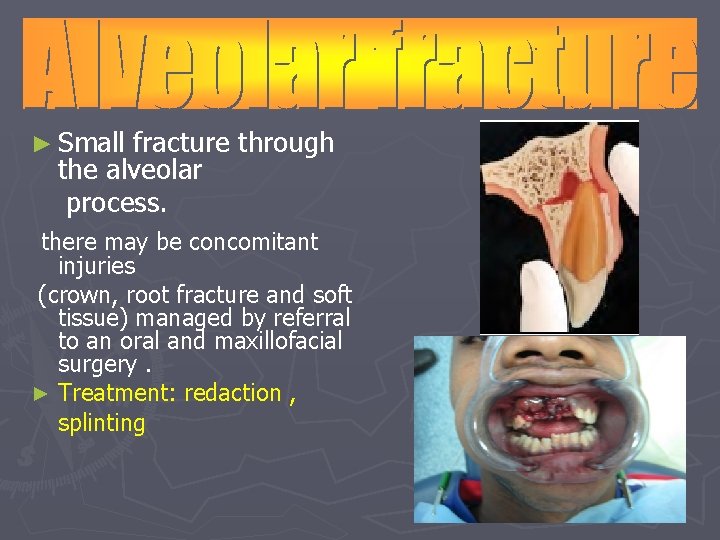 ► Small fracture through the alveolar process. there may be concomitant injuries (crown, root