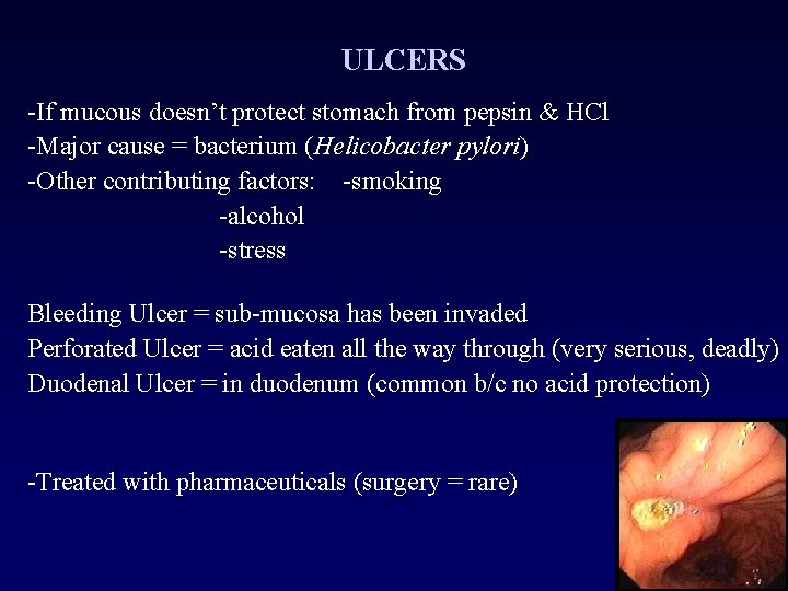 ULCERS -If mucous doesn’t protect stomach from pepsin & HCl -Major cause = bacterium