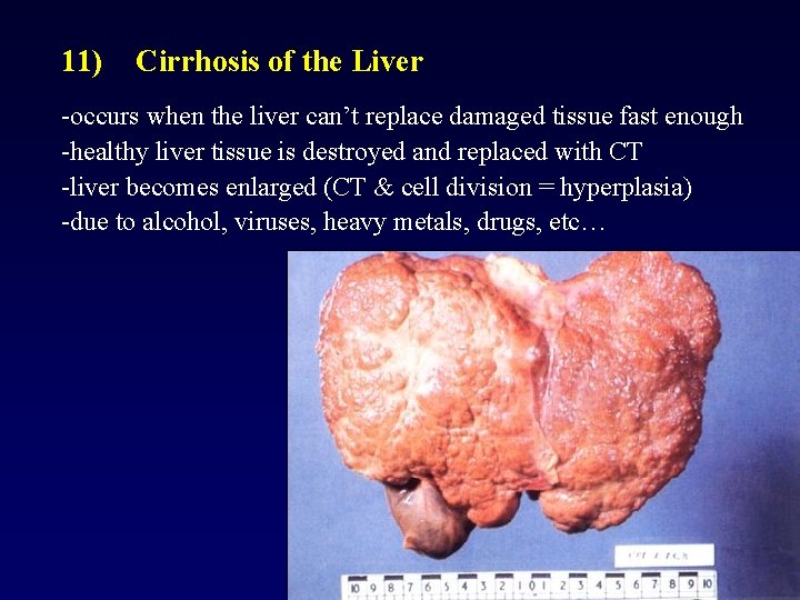 11) Cirrhosis of the Liver -occurs when the liver can’t replace damaged tissue fast