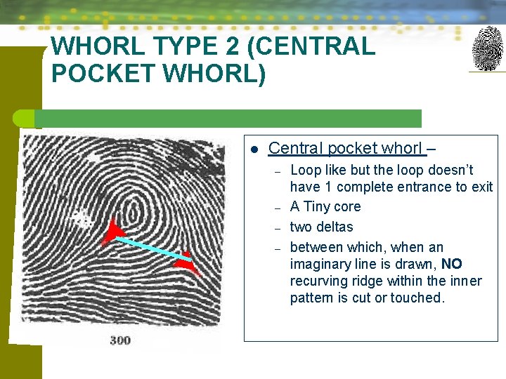 WHORL TYPE 2 (CENTRAL POCKET WHORL) l Central pocket whorl – – – Loop