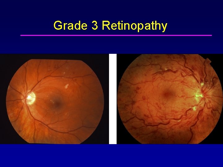 Grade 3 Retinopathy 