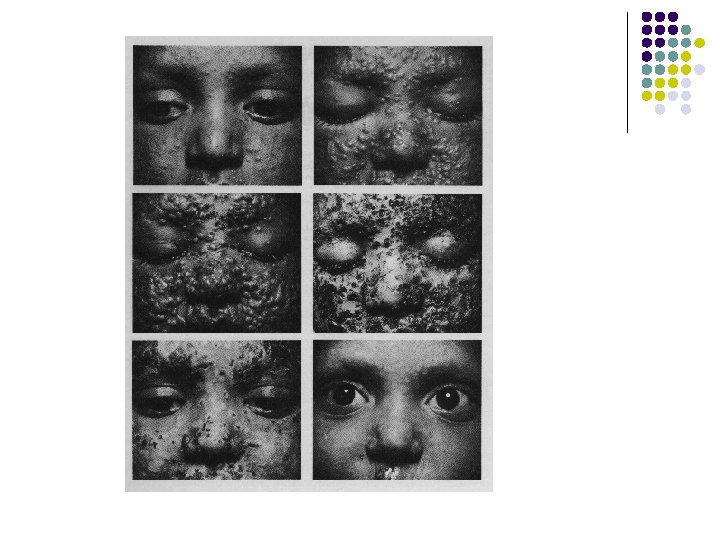 Progression of Smallpox Lesions in Semiconfluent Case Patient Who Survived. Demonstrates Vesicles, Pustules, Scabs