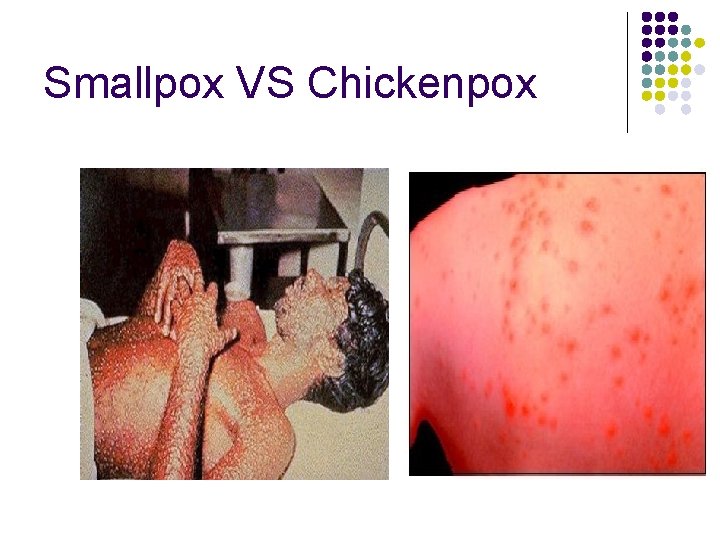 Smallpox VS Chickenpox Photo courtesy of CDC PHIL 