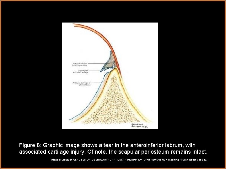 Figure 6: Graphic image shows a tear in the anteroinferior labrum, with associated cartilage