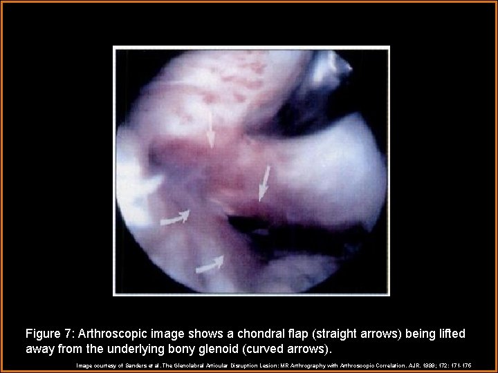 Figure 7: Arthroscopic image shows a chondral flap (straight arrows) being lifted away from