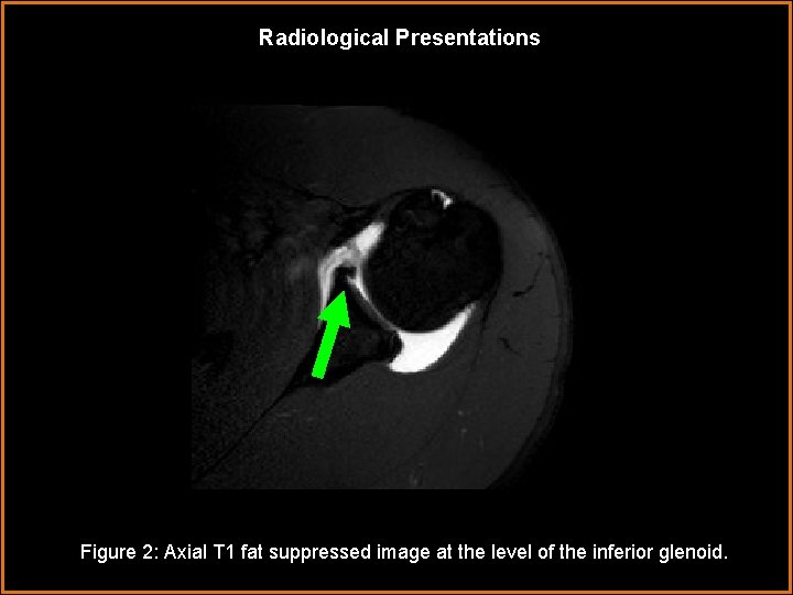 Radiological Presentations Figure 2: Axial T 1 fat suppressed image at the level of