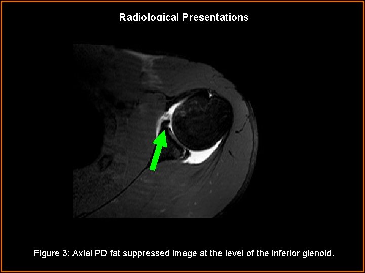 Radiological Presentations Figure 3: Axial PD fat suppressed image at the level of the