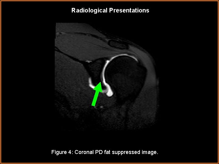 Radiological Presentations Figure 4: Coronal PD fat suppressed image. 