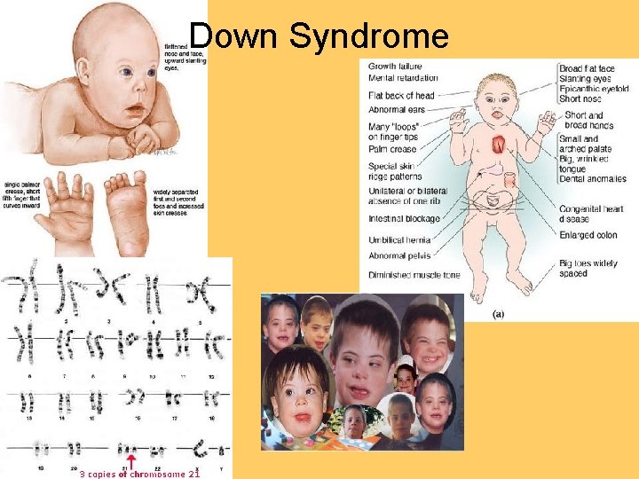 Down Syndrome 