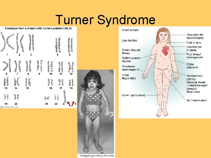 Turner Syndrome 