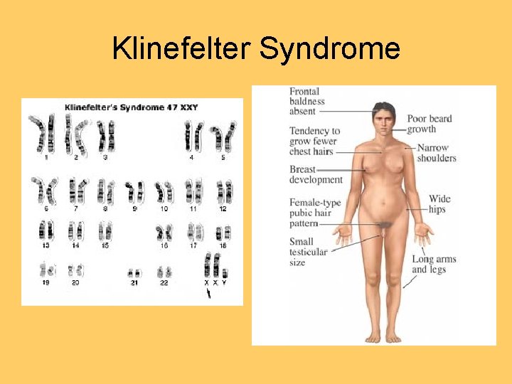 Klinefelter Syndrome 