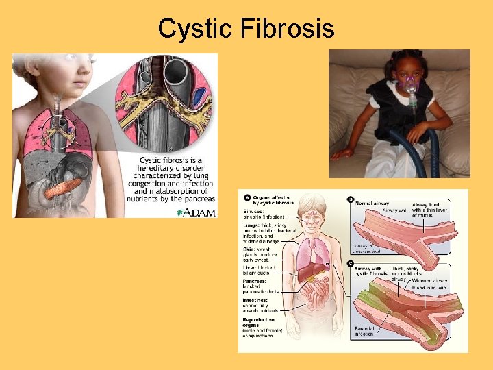 Cystic Fibrosis 