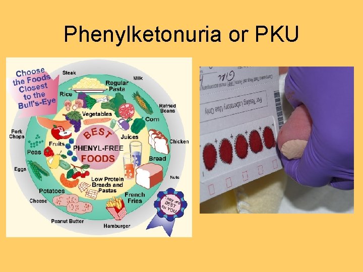 Phenylketonuria or PKU Phenylketonuria or PKU