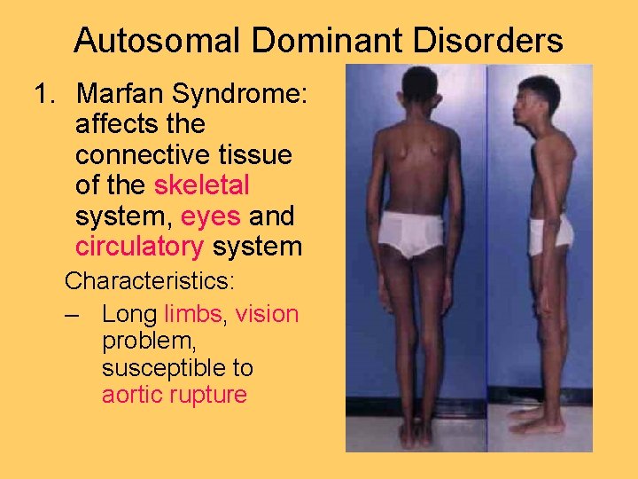 Autosomal Dominant Disorders 1. Marfan Syndrome: affects the connective tissue of the skeletal system,