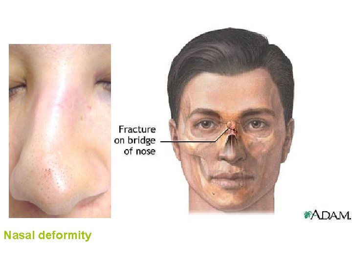 Nasal deformity 