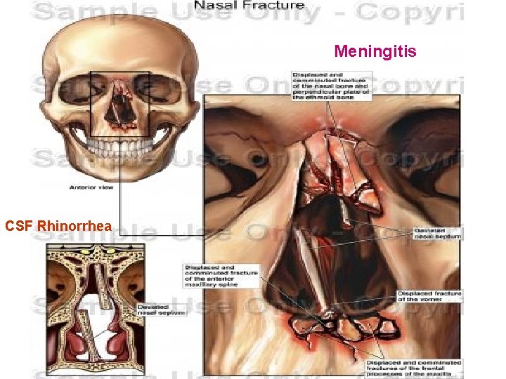 Meningitis CSF Rhinorrhea 