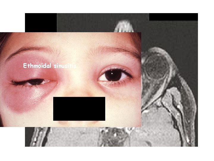 Ethmoidal sinusitis 