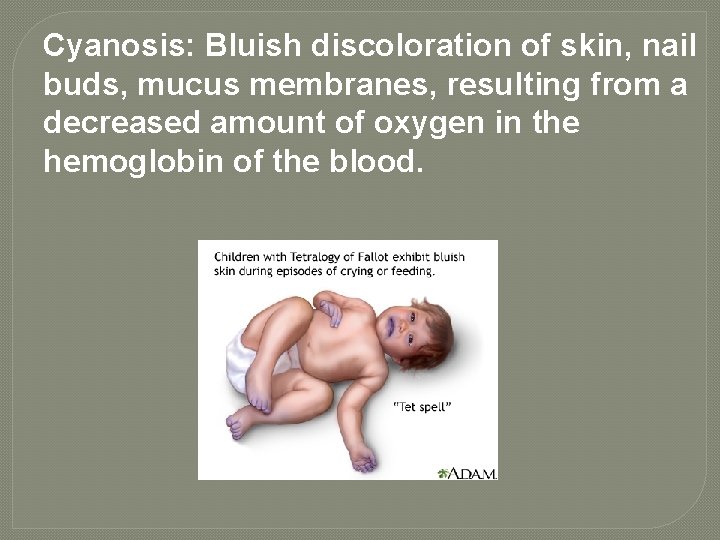 Cyanosis: Bluish discoloration of skin, nail buds, mucus membranes, resulting from a decreased amount