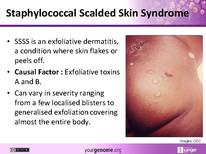Staphylococcal Scalded Skin Syndrome • SSSS is an exfoliative dermatitis, a condition where skin