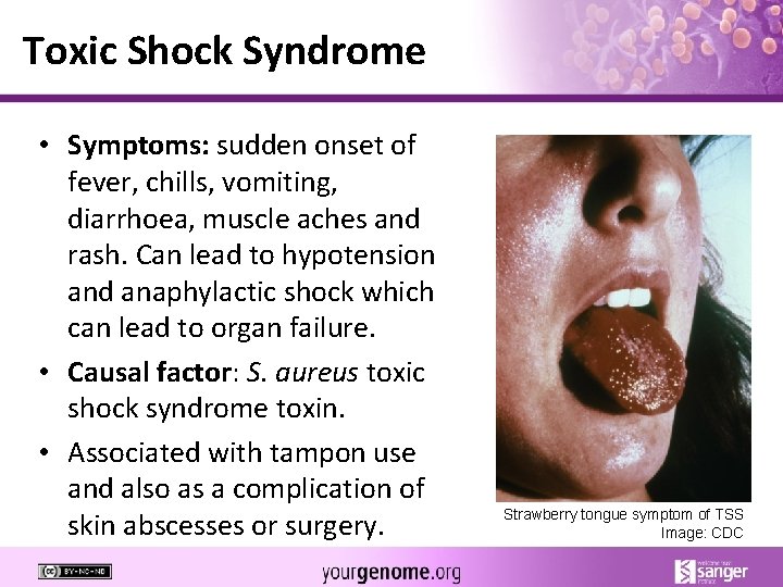 Toxic Shock Syndrome • Symptoms: sudden onset of fever, chills, vomiting, diarrhoea, muscle aches