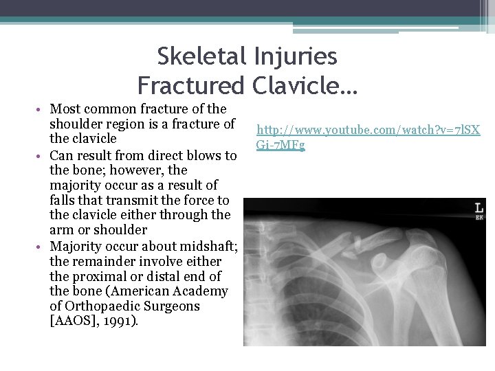 Skeletal Injuries Fractured Clavicle… • Most common fracture of the shoulder region is a