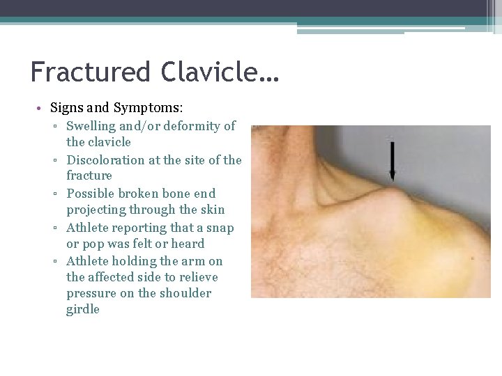 Fractured Clavicle… • Signs and Symptoms: ▫ Swelling and/or deformity of ▫ ▫ the