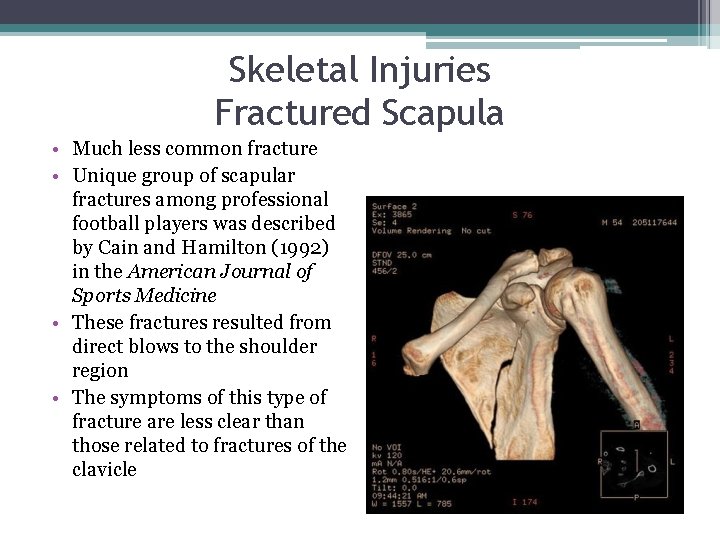 Skeletal Injuries Fractured Scapula • Much less common fracture • Unique group of scapular