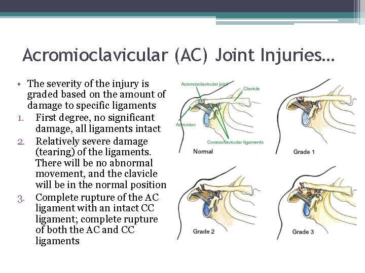 Acromioclavicular (AC) Joint Injuries… • The severity of the injury is graded based on