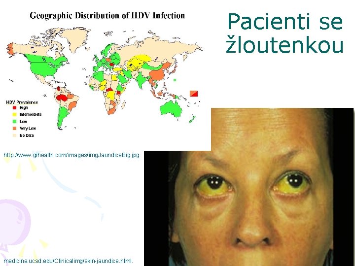 Pacienti se žloutenkou http: //www. gihealth. com/images/img. Jaundice. Big. jpg medicine. ucsd. edu/Clinicalimg/skin-jaundice. html.