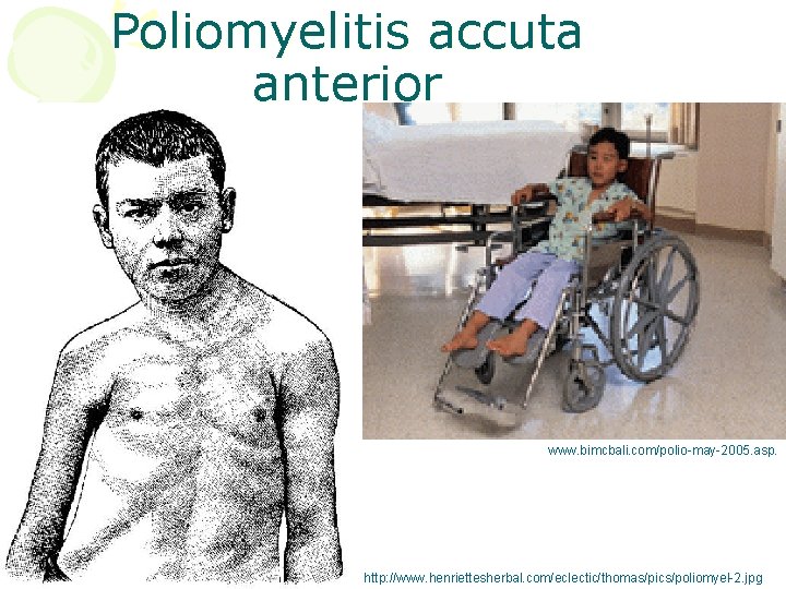 Poliomyelitis accuta anterior www. bimcbali. com/polio-may-2005. asp. http: //www. henriettesherbal. com/eclectic/thomas/pics/poliomyel-2. jpg 