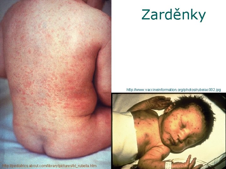 Zarděnky http: //www. vaccineinformation. org/photos/rubeiac 002. jpg http: //pediatrics. about. com/library/pictures/bl_rubella. htm 