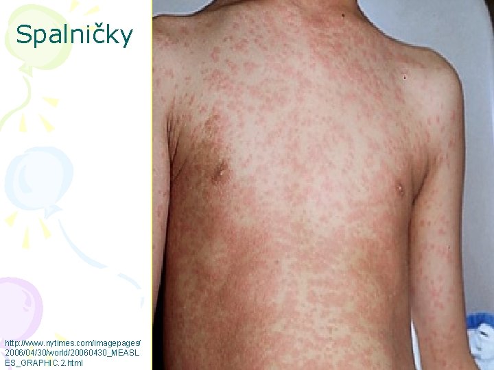 Spalničky http: //www. nytimes. com/imagepages/ 2006/04/30/world/20060430_MEASL ES_GRAPHIC. 2. html 