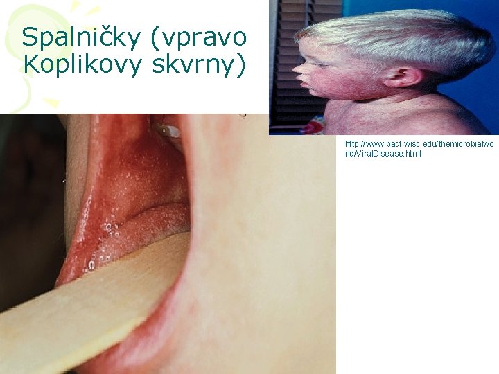 Spalničky (vpravo Koplikovy skvrny) http: //www. bact. wisc. edu/themicrobialwo rld/Viral. Disease. html 