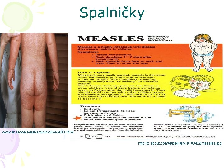 Spalničky www. lib. uiowa. edu/hardin/md/measles. html. http: //z. about. com/d/pediatrics/1/0/e/2/measles. jpg 
