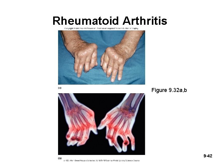Rheumatoid Arthritis Figure 9. 32 a, b 9 -42 Rheumatoid Arthritis Figure 9. 32 a, b 9 -42