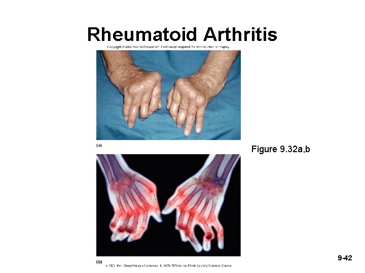 Rheumatoid Arthritis Figure 9. 32 a, b 9 -42 