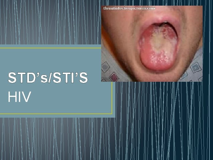 STD’s/STI’S HIV 