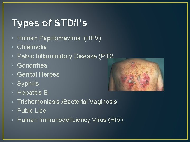 Types of STD/I’s • • • Human Papillomavirus (HPV) Chlamydia Pelvic Inflammatory Disease (PID)