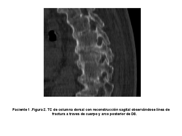 Paciente 1. Figura 2. TC de columna dorsal con reconstrucción sagital observándose línea de