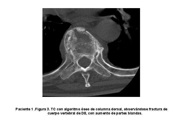 Paciente 1. Figura 3. TC con algoritmo óseo de columna dorsal, observándose fractura de