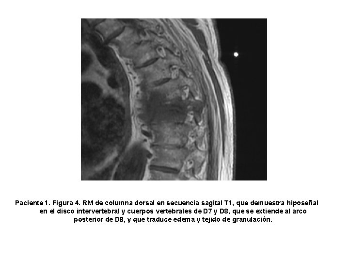 Paciente 1. Figura 4. RM de columna dorsal en secuencia sagital T 1, que