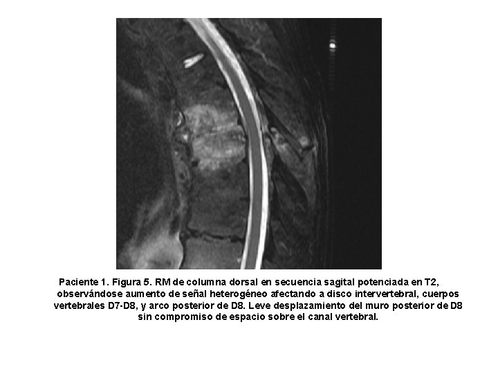 Paciente 1. Figura 5. RM de columna dorsal en secuencia sagital potenciada en T