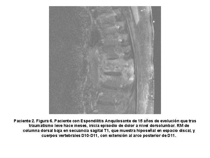 Paciente 2. Figura 6. Paciente con Espondilitis Anquilosante de 15 años de evolución que